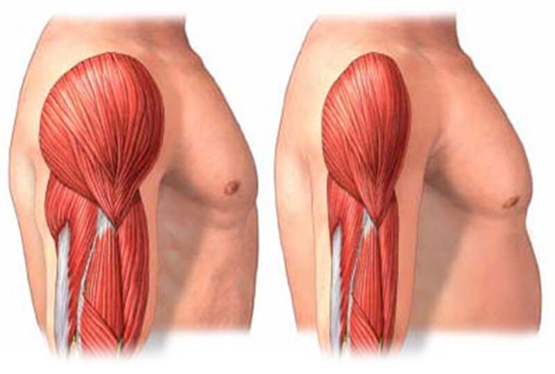 Graphic showing a side view of two male torsos. The shoulder and arm muscles are visible. The image on the left shows healthy muscles. The image on the right shows smaller muscles caused by sarcopenia.